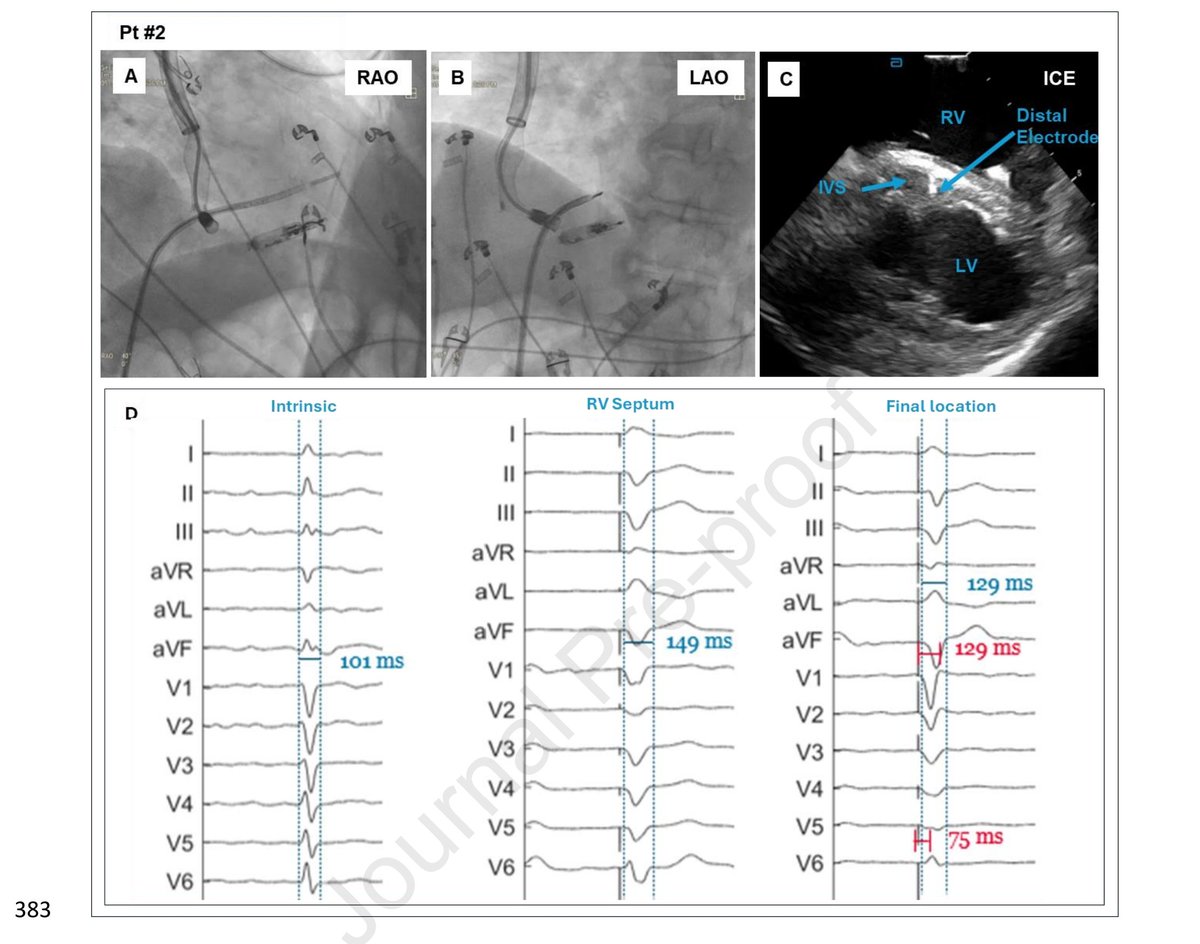 Xueying Chen, MD, PhD, FHRS (@xyc1982) on Twitter photo No chance to see this one of the most want-to-see LBCT. I'm very curious what were the live comments. From all 12 cases, just 1 was recognized as "LBBP" "by the authors" with tip to LV still 5mm. DSP might be feasible using this LP system.<a href="/MdHuang/">Weijian Huang</a> <a href="/DrRoderickTung/">Roderick Tung</a> <a href="/curilakarol/">curilakarol</a> No chance to see this one of the most want-to-see LBCT. I'm very curious what were the live comments. From all 12 cases, just 1 was recognized as "LBBP" "by the authors" with tip to LV still 5mm. DSP might be feasible using this LP system.<a href="/MdHuang/">Weijian Huang</a> <a href="/DrRoderickTung/">Roderick Tung</a> <a href="/curilakarol/">curilakarol</a>