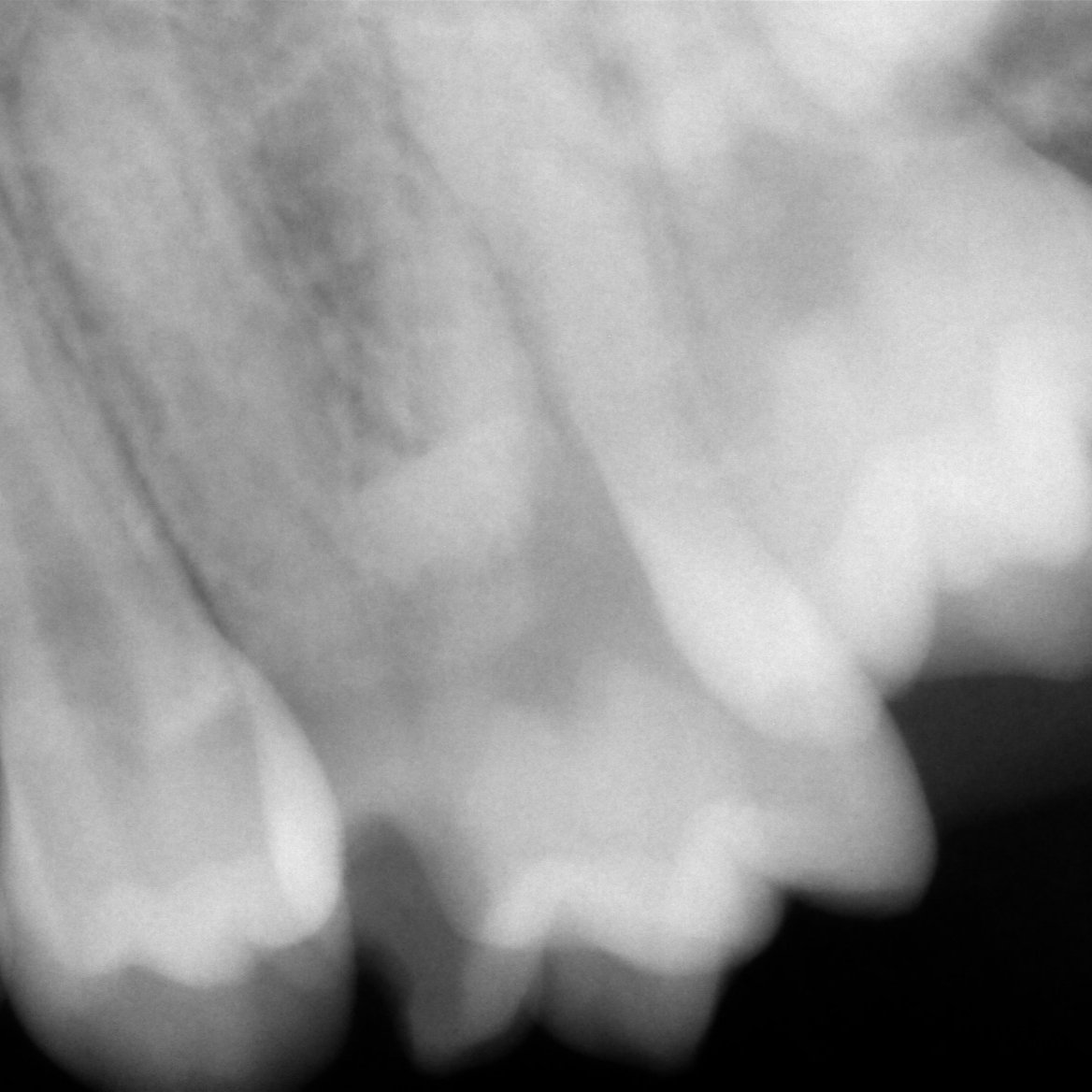 dentist_amar617's tweet image. #Appexogneis 
 Pulpotmy to upper left 1st molar #26 done under Rubber dam isolation  
Caries were removed, followed by bleeding management 
Coronal  pulp removed  
Scrold down to see the final result 
#saveatooth