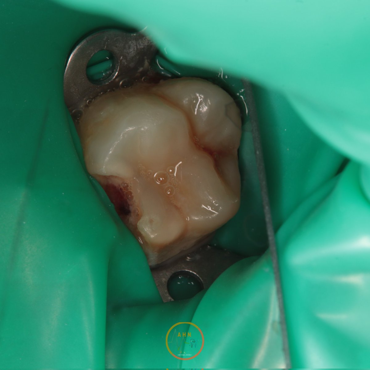 dentist_amar617's tweet image. #Appexogneis 
 Pulpotmy to upper left 1st molar #26 done under Rubber dam isolation  
Caries were removed, followed by bleeding management 
Coronal  pulp removed  
Scrold down to see the final result 
#saveatooth