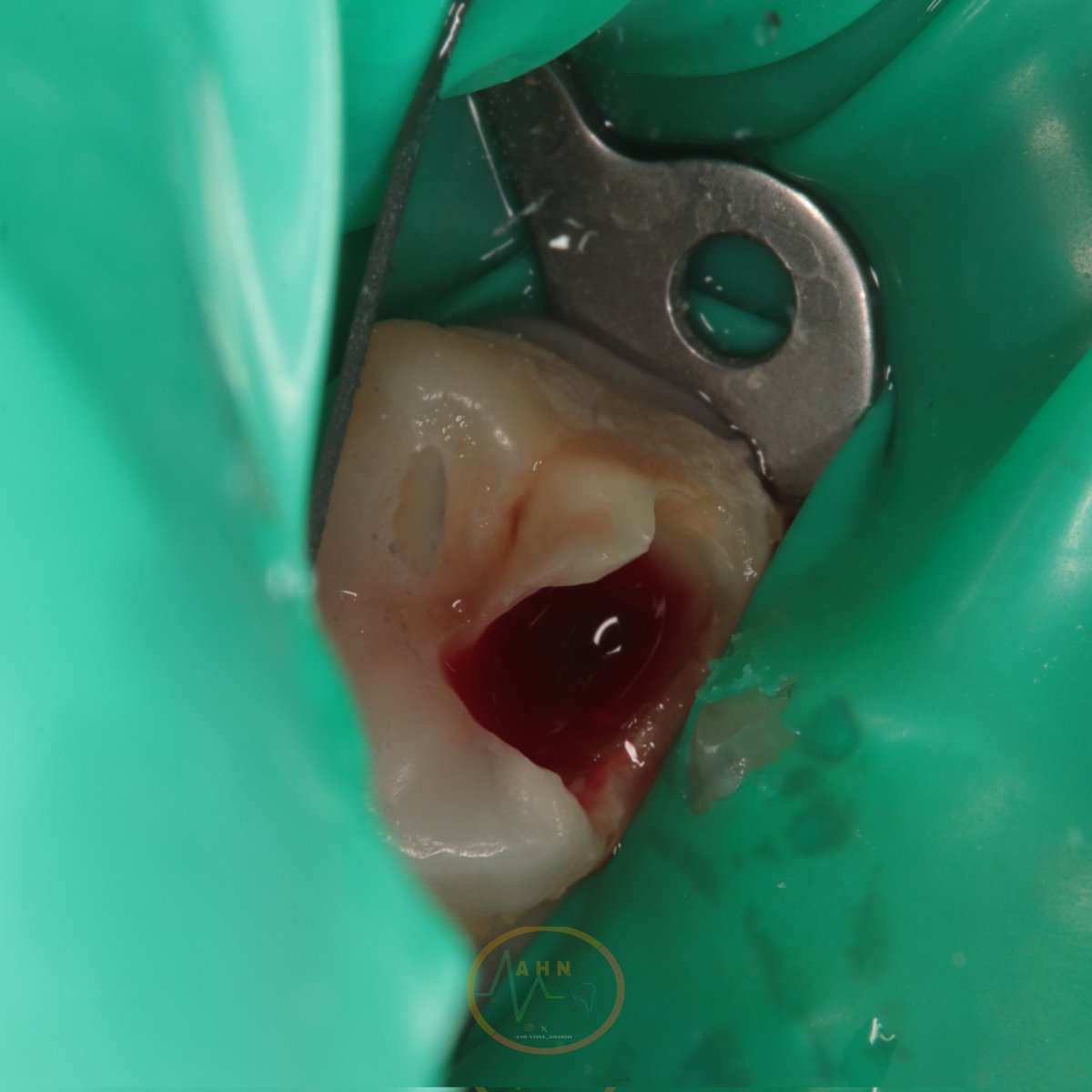 dentist_amar617's tweet image. #Appexogneis 
 Pulpotmy to upper left 1st molar #26 done under Rubber dam isolation  
Caries were removed, followed by bleeding management 
Coronal  pulp removed  
Scrold down to see the final result 
#saveatooth