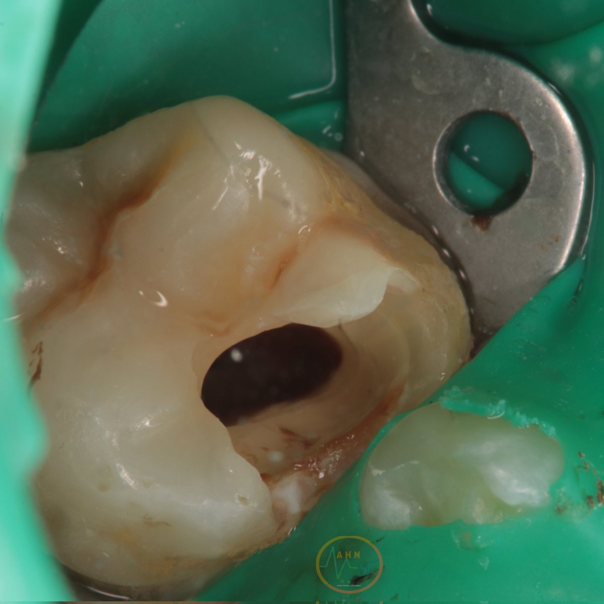 dentist_amar617's tweet image. apical pulp appears  to me normal bleeding stoped
Covered with White #MTA followed by composite 
Follwed up  for  2weeks shwowing normal response to cold test 
#saveatooth  #young_pulp