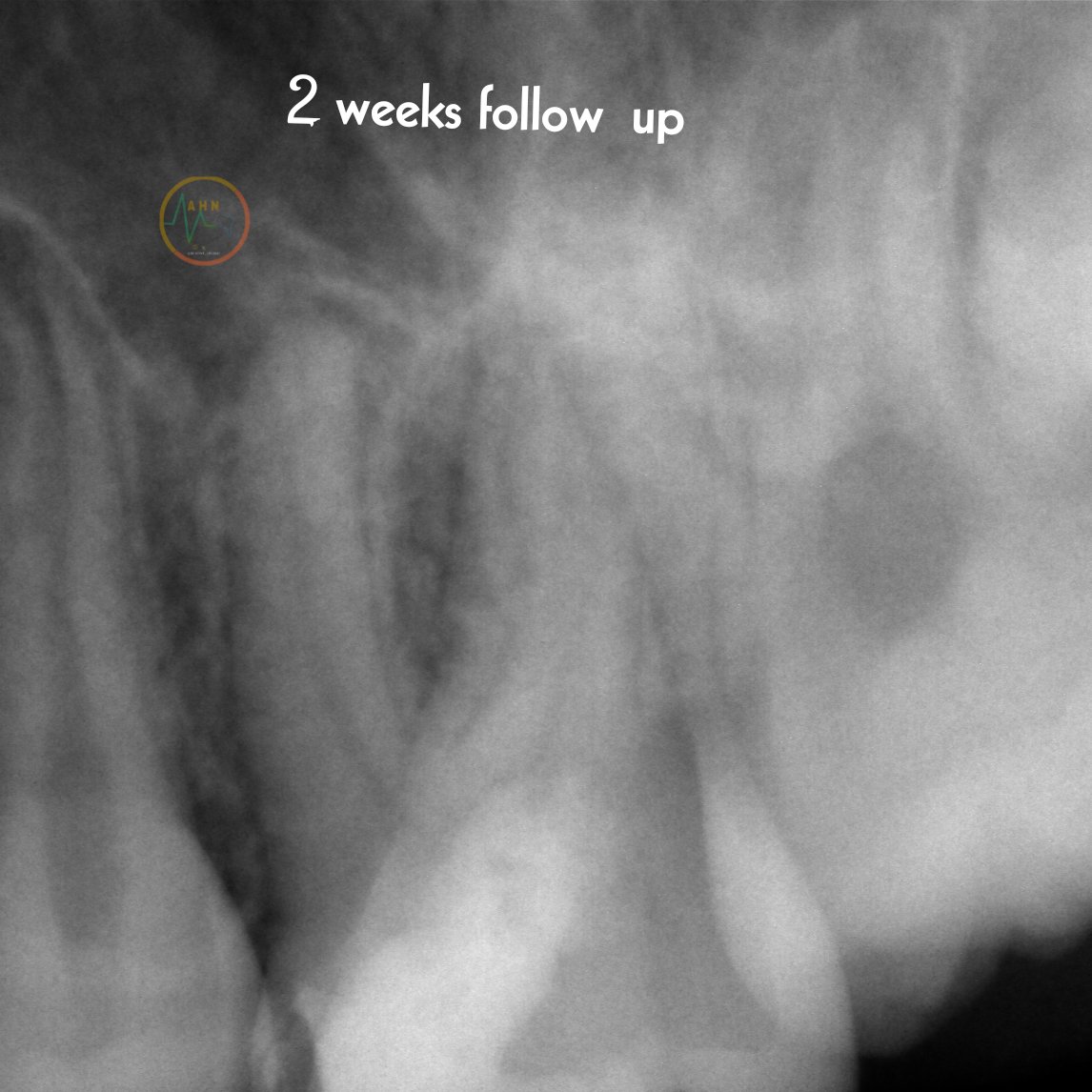 dentist_amar617's tweet image. apical pulp appears  to me normal bleeding stoped
Covered with White #MTA followed by composite 
Follwed up  for  2weeks shwowing normal response to cold test 
#saveatooth  #young_pulp