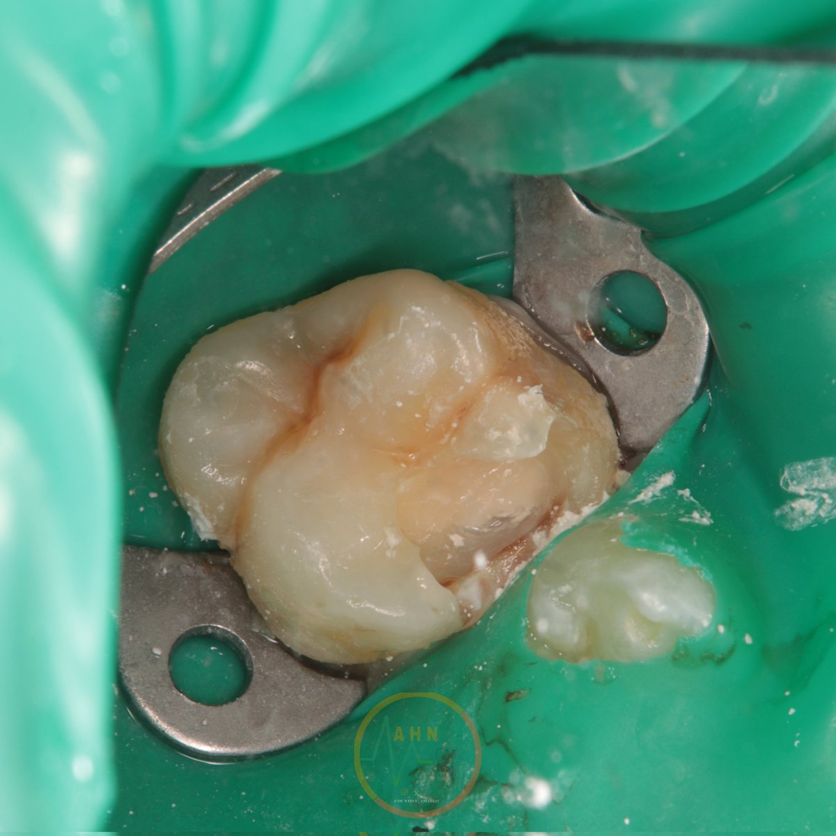 dentist_amar617's tweet image. apical pulp appears  to me normal bleeding stoped
Covered with White #MTA followed by composite 
Follwed up  for  2weeks shwowing normal response to cold test 
#saveatooth  #young_pulp