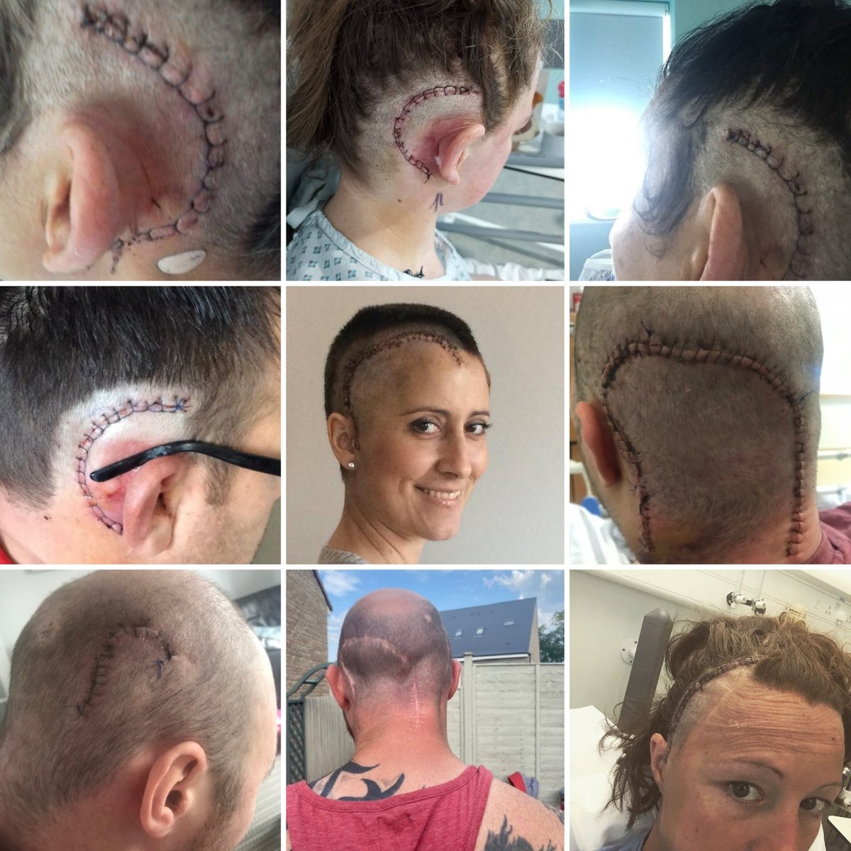 Just because the scar is often hidden, doesn't mean the struggle is over.

Brain tumours leave lasting impacts that most people never see.

Healing is ongoing — and strength isn't always visible.

#BrainTumourAwareness #HiddenStruggles #InvisibleIllness