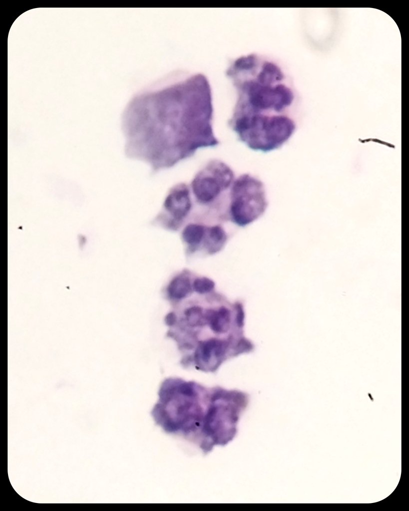 ♂️ Medical record: Melanoma ➕ chemotherapy - immunotherapy.
💉 Lumbar puncture.  Cerebrospinal fluid.
🔬 Negative for Melanoma.  Incidental finding...

#Cytology #CytoPath #PathX #PathTwitter