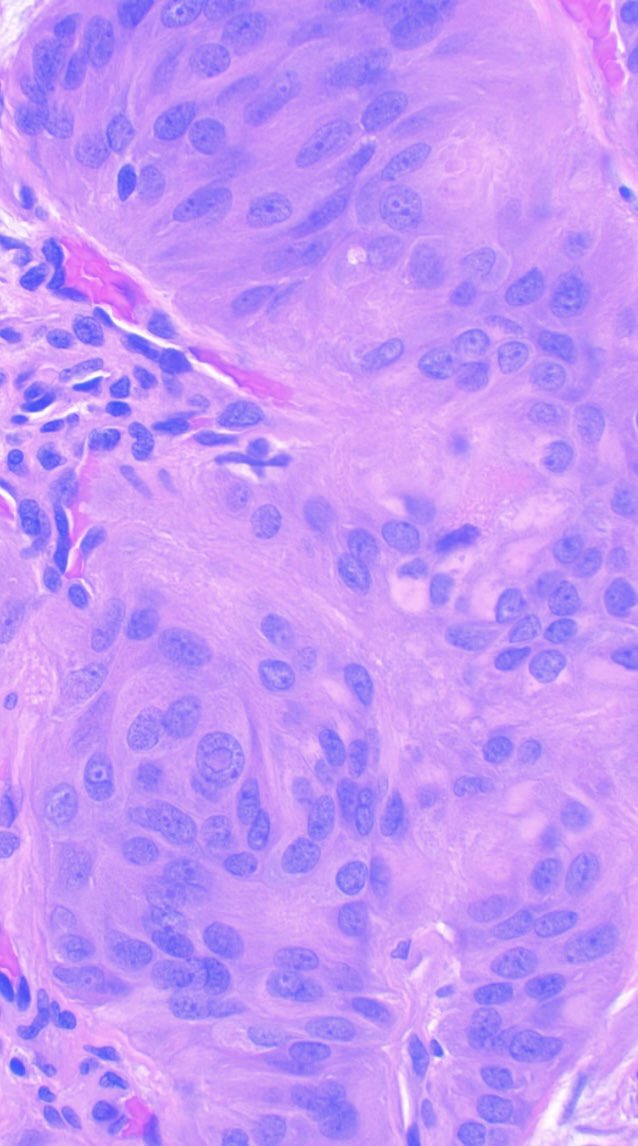 JCandidoXavier's tweet image. Medicine is full of exceptions

#thyroid tumor with nuclear inclusions is not always PTC

Ki-67 can be a membrane marker too

HYALINIZING TRABECULAR TUMOR 🎈

#path #pathology #cancer #endocrine