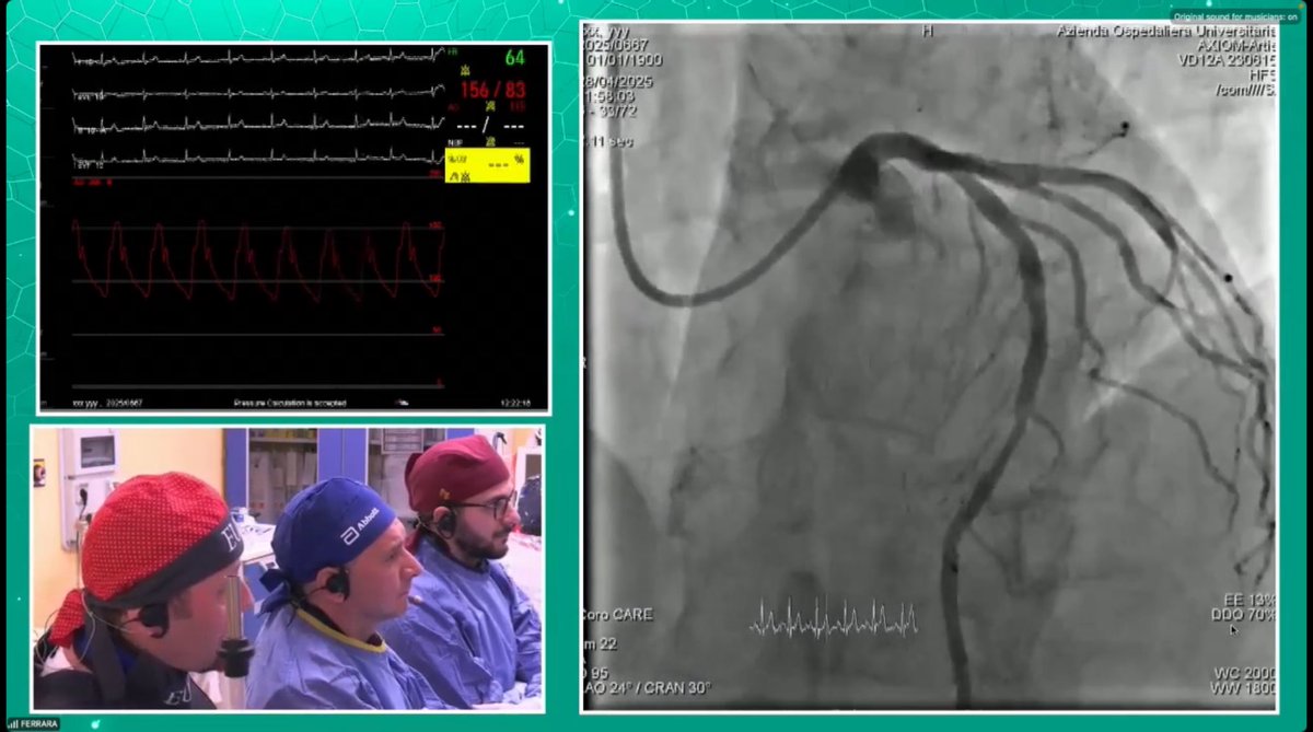 Mona Tirén (@monaltiren) on Twitter photo #CoronaryPhysiology
#MedEd
LIVE CASE
Ferrara Italy 🇮🇹
CT-guidance
Anatomy + physiology
👋 <a href="/SimoneBiscaglia/">Simone Biscaglia</a>
<a href="/GianlucaCampo78/">Gianluca Campo</a>
👨💻 Join VIRTUALLY
via the OPTIMA app
apps.apple.com/dk/app/optima-…
T H E PHYSIOLOGY COURSE
➡️ 28-29/04 Belgium🇧🇪
registration.physiologycourse-be25.com/tpc25 #CoronaryPhysiology
#MedEd
LIVE CASE
Ferrara Italy 🇮🇹
CT-guidance
Anatomy + physiology
👋 <a href="/SimoneBiscaglia/">Simone Biscaglia</a>
<a href="/GianlucaCampo78/">Gianluca Campo</a>
👨💻 Join VIRTUALLY
via the OPTIMA app
apps.apple.com/dk/app/optima-…
T H E PHYSIOLOGY COURSE
➡️ 28-29/04 Belgium🇧🇪
registration.physiologycourse-be25.com/tpc25