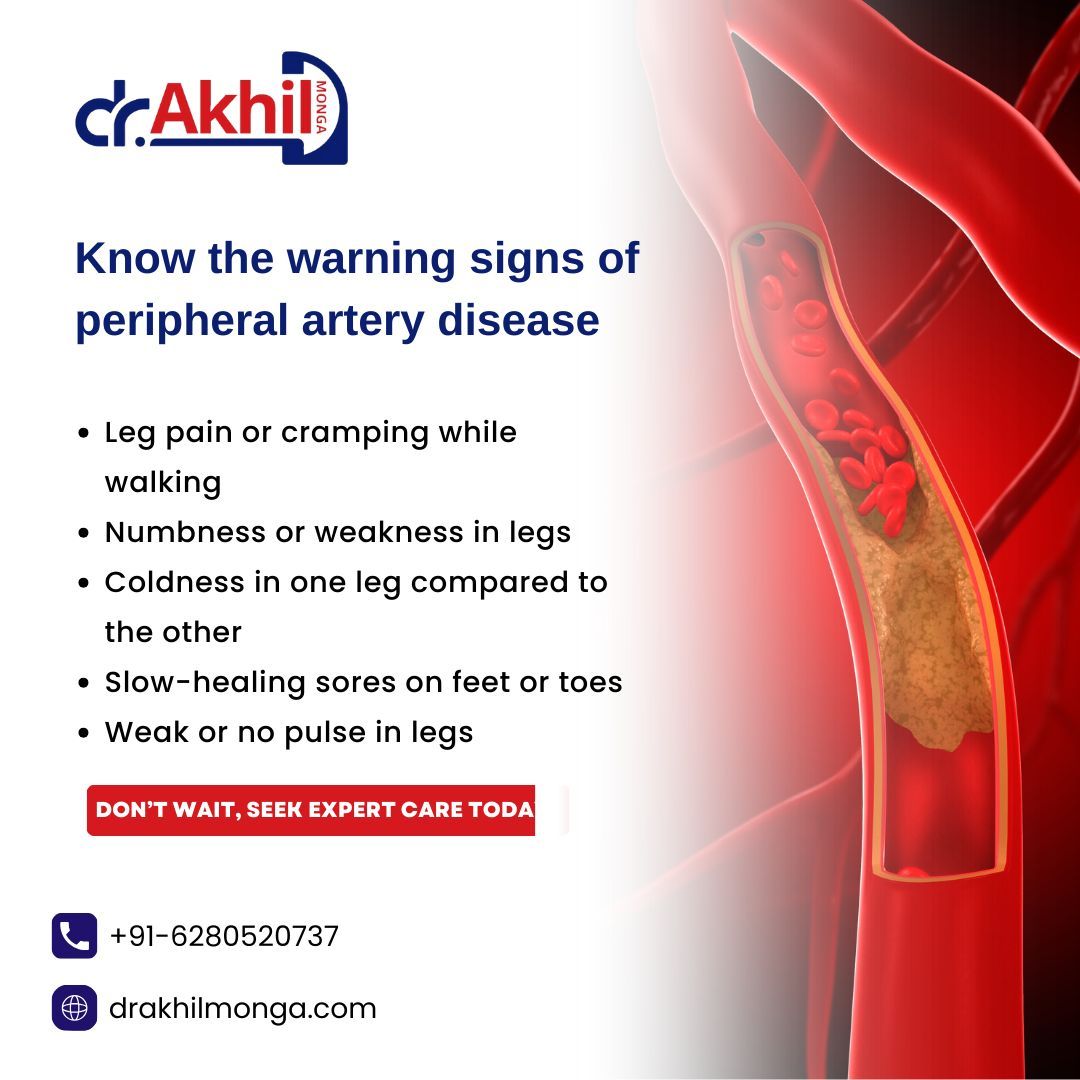 Signs of Peripheral Artery Disease (PAD)-leg pain while walking, numbness, coldness, slow-healing sores, and weak pulse. If you notice these, consult Dr Akhil Monga now.

📞 +91-6280520737 🌐 drakhilmonga.com
.
.
#PeripheralArteryDisease #PADAwareness #DrAkhilMonga