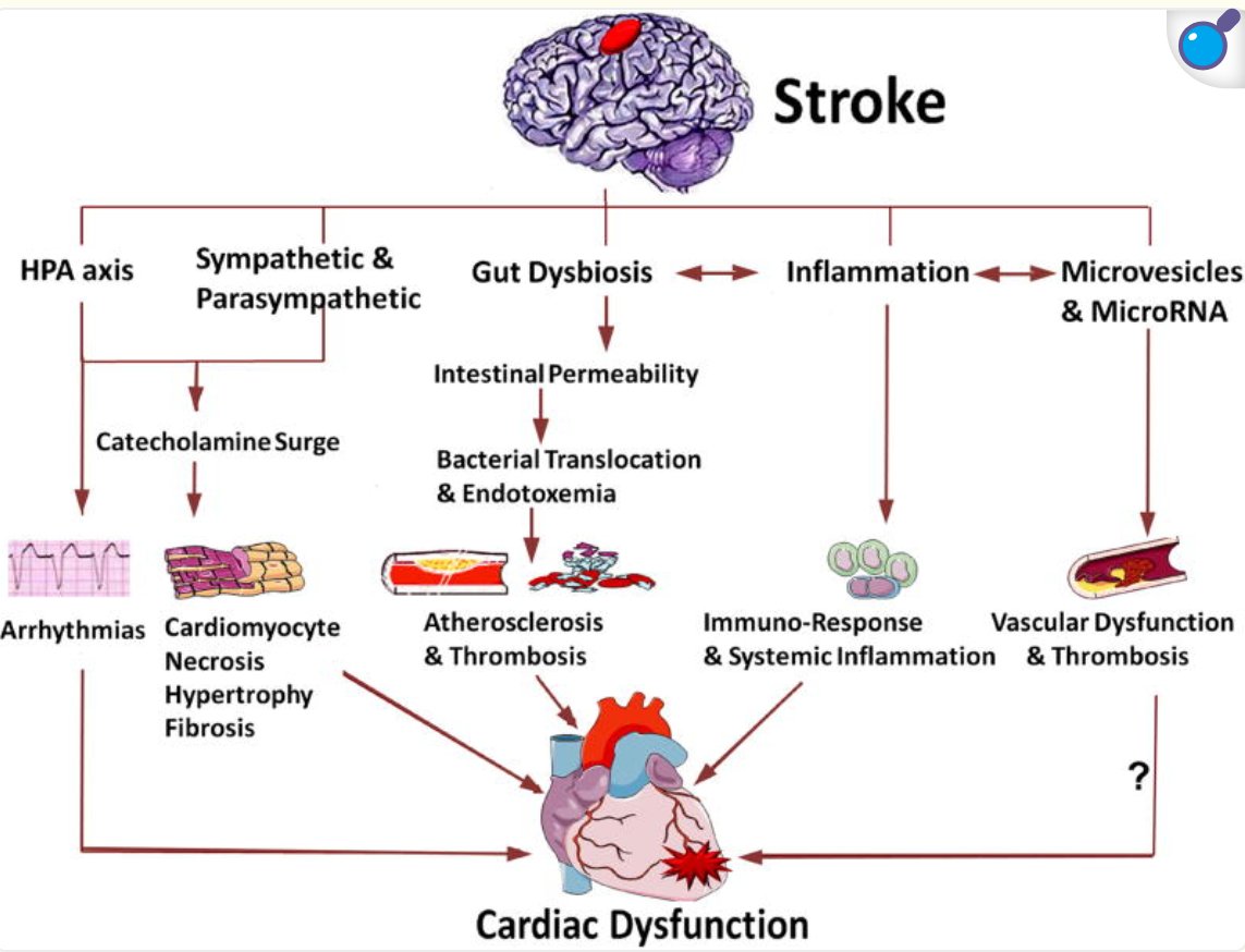 Did you know 67% of ischemic #stroke patients experience ECG abnormalities within 24 hours? 
Stroke-induced cardiac dysfunction is a major challenge requiring integrated care. 

🖇️tinyurl.com/2e4ptpnp

#BrainHeartAxis🫀🧠
<a href="/CircRes/">Circulation Research</a> <a href="/JacopoImberti/">Jacopo Imberti</a> <a href="/annapodlasek/">Anna Podlasek</a> <a href="/L_Bergamaschi/">Luca Bergamaschi</a>
