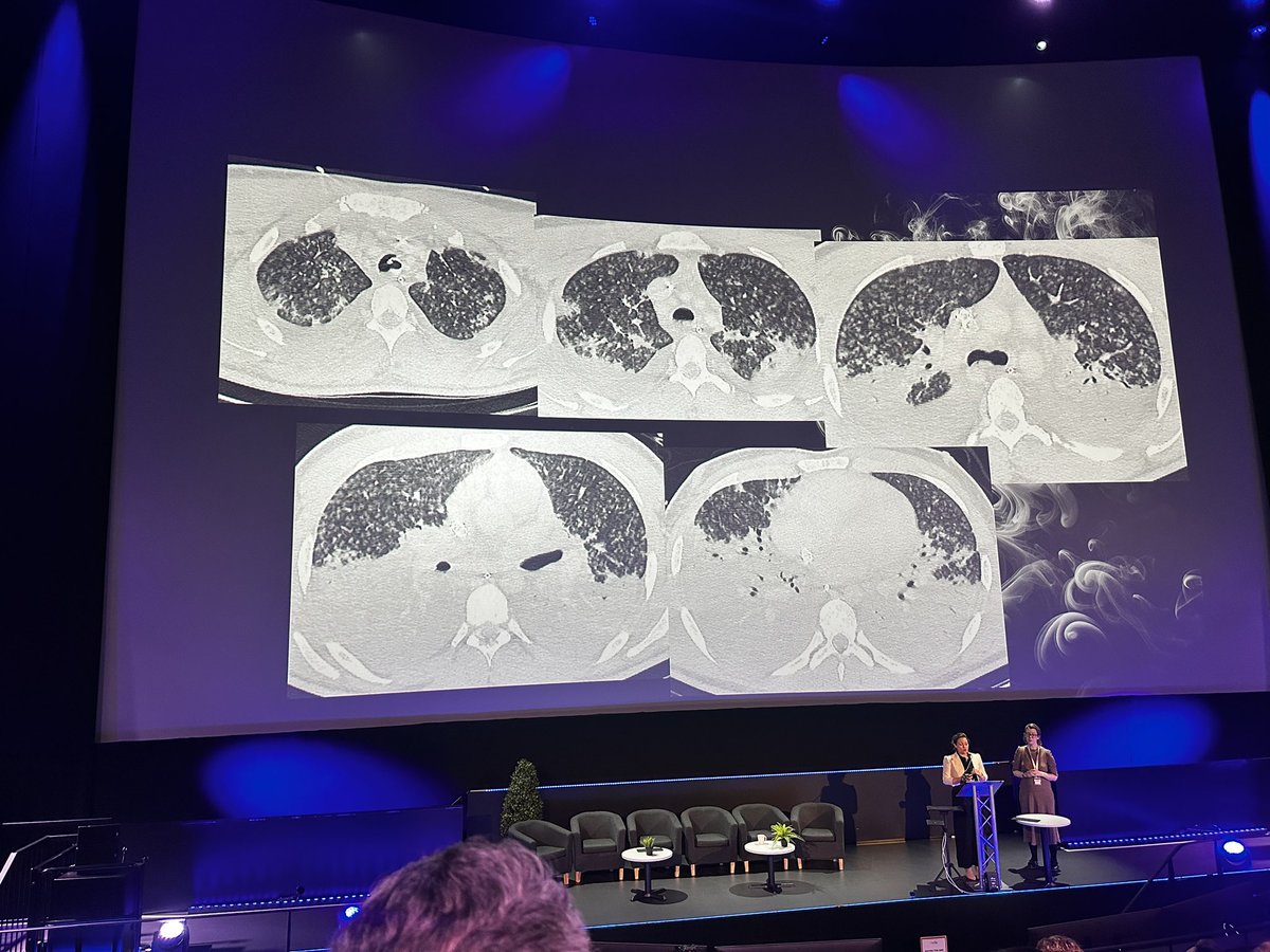 juniorBSTI's tweet photo. 🩻  BSTI ASM 2025 Day 1

🫁  Fantastic lecture on inhalation lung injury seen with rising vape usage in the UK l
📣 Dr. Allanah Barker @allanah_barker Consultant Radiologist and Dr. Laura Succony Respiratory Consultant @laurasuccony 

@BSTImaging @_the_SRT @radiologyannet1 https://t.co/tTXfmTYlcy