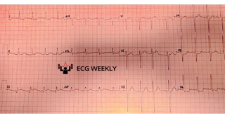 A 76-year-old man presents to the emergency department with shortness of breath, severe weakness, diaphoresis, and confusion. The following ECG is obtained on arrival.....ecgweekly.com/weekly-workout…