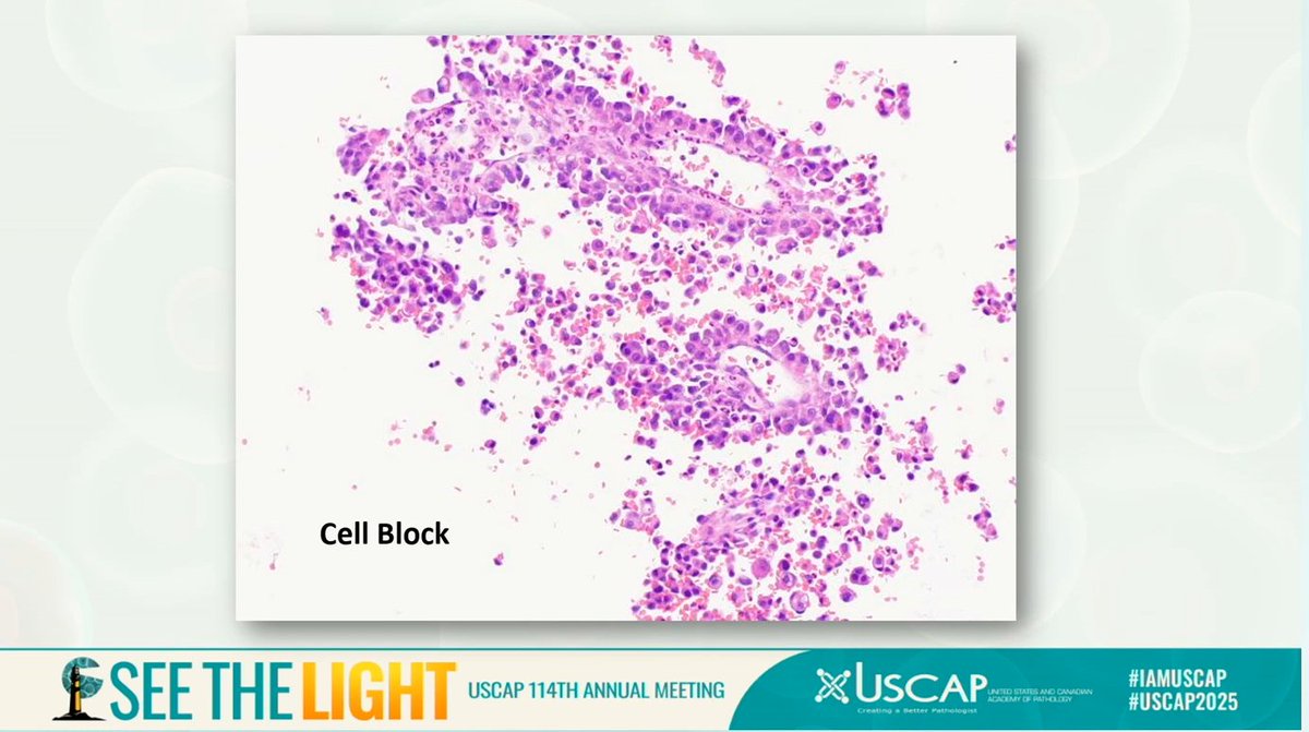 Best way/more efficient way to process a serous/cavity fluid
-Create one thinprep slide
-The residue should all go to a cell block

Thinprep is a filtration process and it gets you a cleaner sample

Dr. Siddiqi #USCAP25 #pathology #PathX