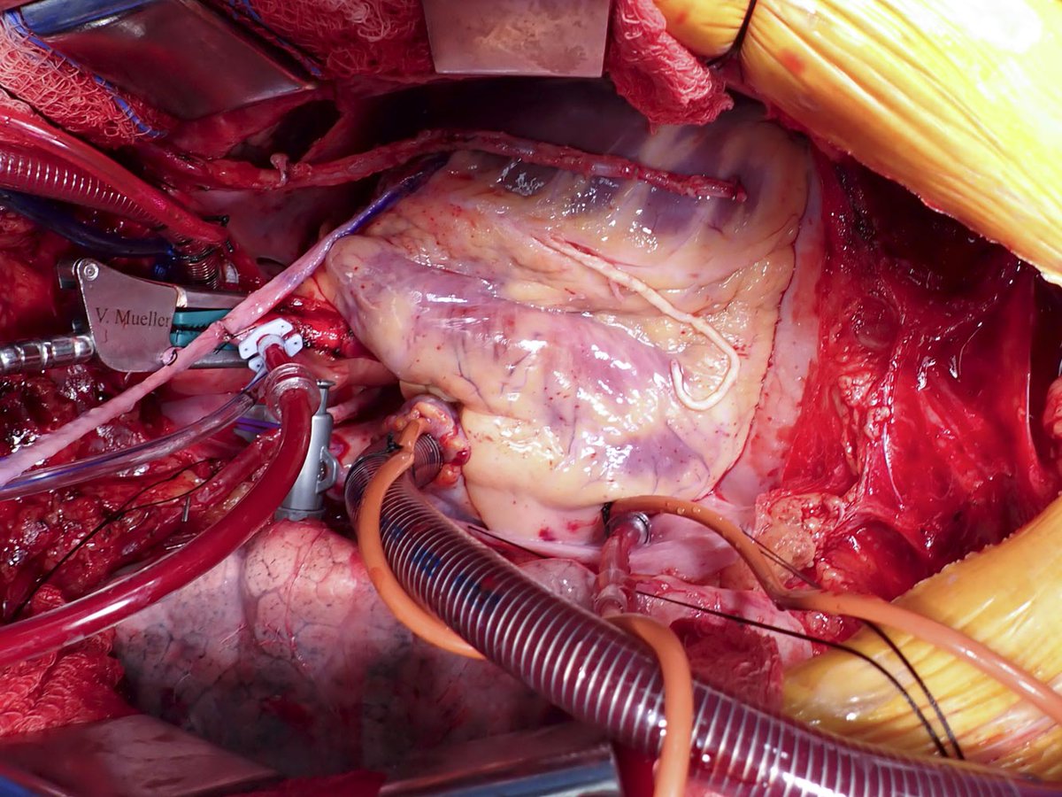 Anthony Zaki, MD (@anthonyzakimd) on Twitter photo Intraop view: Long-segment LAD #endarterectomy with long distal tail for chronic LAD occlusion and refractory angina — one of the most satisfying moments in #CABG surgery! <a href="/CleClinicHVTI/">Cleveland Clinic Heart, Vascular & Thoracic</a> @ClevelandClinicMD <a href="/ctsnetorg/">CTSNet</a> <a href="/ACCinTouch/">American College of Cardiology</a> Intraop view: Long-segment LAD #endarterectomy with long distal tail for chronic LAD occlusion and refractory angina — one of the most satisfying moments in #CABG surgery! <a href="/CleClinicHVTI/">Cleveland Clinic Heart, Vascular & Thoracic</a> @ClevelandClinicMD <a href="/ctsnetorg/">CTSNet</a> <a href="/ACCinTouch/">American College of Cardiology</a>