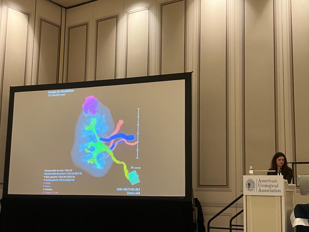 EAU-YAU Renal Cancer Working Group (@eauyau_renalca) on Twitter photo Technology most commonly used for solid renal masses now applied to upper tract urothelial ca.
<a href="/GaelleMargue/">Gaëlle Margue</a> presenting interesting data on 3D image guided robotic partial Npx for intestinal UTUC. May be considered in selected cases with imp nephron-sparing indications #AUA25 Technology most commonly used for solid renal masses now applied to upper tract urothelial ca.
<a href="/GaelleMargue/">Gaëlle Margue</a> presenting interesting data on 3D image guided robotic partial Npx for intestinal UTUC. May be considered in selected cases with imp nephron-sparing indications #AUA25