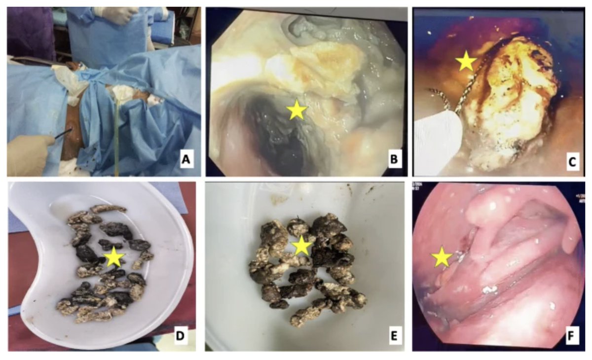 Indian Journal of Gastroenterology (@ijg_journal) on Twitter photo Endoscopic interventions for managing pancreatic fluid collections associated with acute pancreatitis: A state-of-the-art review (with videos)
MUST READ TODAY
Dr Pramod Garg et al <a href="/aiims_newdelhi/">AIIMS, New Delhi 🇮🇳</a>
link.springer.com/article/10.100… Endoscopic interventions for managing pancreatic fluid collections associated with acute pancreatitis: A state-of-the-art review (with videos)
MUST READ TODAY
Dr Pramod Garg et al <a href="/aiims_newdelhi/">AIIMS, New Delhi 🇮🇳</a>
link.springer.com/article/10.100…