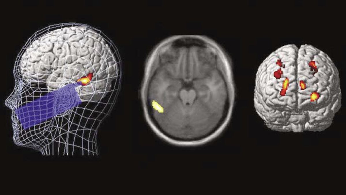 Jonathanjarecki's tweet image. "Effects of a commercial mobile phone on regional cerebral blood flow (rCBF) in healthy humans using positron emission tomography (PET) imaging.
A double-blind, counterbalanced study design with 12 male subjects performing a computer-controlled verbal working memory task…