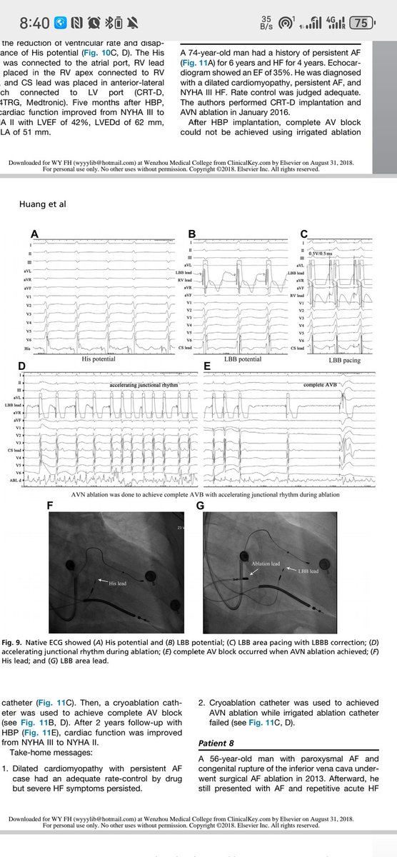 Weijian Huang (@mdhuang) on Twitter photo Pleasure to meet so many friends in HRS. what do you think of the success rate of true LBB Capture in real world? I reviewed the picture of cases performed in 2017-2018 , typical LB potentials and S-LBBP <a href="/curilakarol/">curilakarol</a> <a href="/DrRoderickTung/">Roderick Tung</a> <a href="/teremoraleda/">Teresa_Moraleda</a> <a href="/xyc1982/">Xueying Chen, MD, PhD, FHRS</a> Pleasure to meet so many friends in HRS. what do you think of the success rate of true LBB Capture in real world? I reviewed the picture of cases performed in 2017-2018 , typical LB potentials and S-LBBP <a href="/curilakarol/">curilakarol</a> <a href="/DrRoderickTung/">Roderick Tung</a> <a href="/teremoraleda/">Teresa_Moraleda</a> <a href="/xyc1982/">Xueying Chen, MD, PhD, FHRS</a>