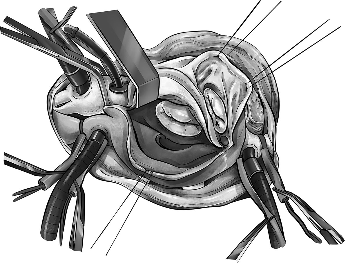 AATS (@aatshq) on Twitter photo Surgical Implantation of Melody Valve in Mitral Position in Infants and Small Children: Toronto SickKids Method from <a href="/OsamiHonjo/">Osami Honjo</a> and <a href="/MimiXDeng/">Mimi Deng</a> at <a href="/UofTCVsurgery/">University of Toronto Cardiac Surgery</a> <a href="/SickKidsNews/">The Hospital for Sick Children (SickKids)</a>. Log in to Operative Techniques in Thoracic and Cardiovascular Surgery to read: doi.org/10.1053/j.opte… Surgical Implantation of Melody Valve in Mitral Position in Infants and Small Children: Toronto SickKids Method from <a href="/OsamiHonjo/">Osami Honjo</a> and <a href="/MimiXDeng/">Mimi Deng</a> at <a href="/UofTCVsurgery/">University of Toronto Cardiac Surgery</a> <a href="/SickKidsNews/">The Hospital for Sick Children (SickKids)</a>. Log in to Operative Techniques in Thoracic and Cardiovascular Surgery to read: doi.org/10.1053/j.opte…