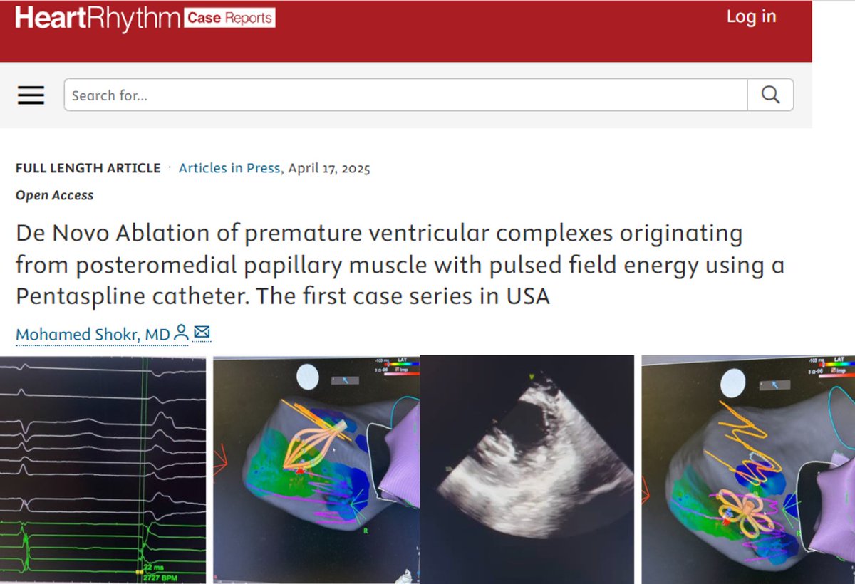 Arab HRS - Heart Rhythm Society (@arabhrs) on Twitter photo 🧵Innovative work from our own dr. <a href="/MohamedRShokr/">Mohamed Rizk Shokr</a> presented #HRS2025🌟! First USA case-series on denovo PM papillary muscle PVC ablation using PFA technology!
With simultaneous publication at <a href="/HRS_CaseReports/">Heart Rhythm Case Reports</a>! Link👇 Congratulations Dr. Shokr👏#Epeeps
heartrhythmcasereports.com/article/S2214-… 🧵Innovative work from our own dr. <a href="/MohamedRShokr/">Mohamed Rizk Shokr</a> presented #HRS2025🌟! First USA case-series on denovo PM papillary muscle PVC ablation using PFA technology!
With simultaneous publication at <a href="/HRS_CaseReports/">Heart Rhythm Case Reports</a>! Link👇 Congratulations Dr. Shokr👏#Epeeps
heartrhythmcasereports.com/article/S2214-…
