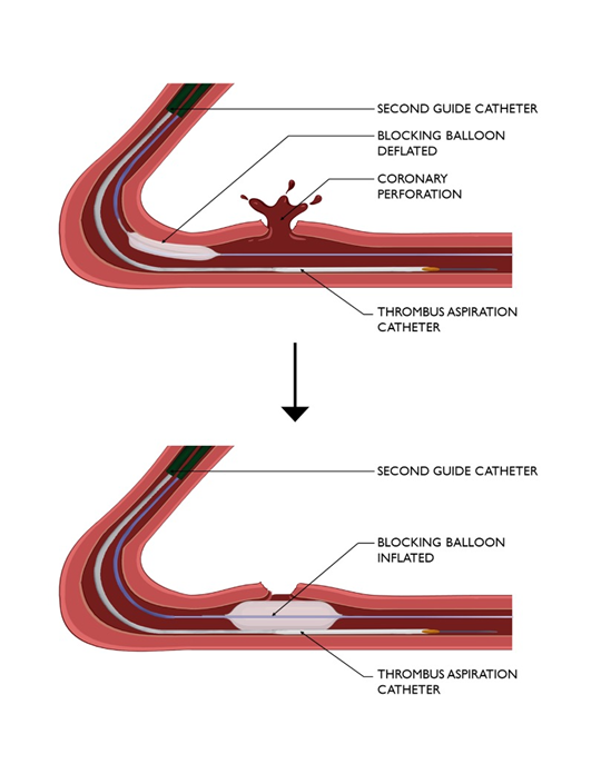 Journal of Invasive Cardiology (@invasivecardiol) on Twitter photo April Review: Update on the Diagnosis and Treatment of Coronary Complications of Percutaneous Coronary Interventions ➡️
hubs.ly/Q03jVt_x0
@sant_j_kumar <a href="/esbrilakis/">Emmanouil Brilakis</a> <a href="/DLBHATTMD/">Dr. Deepak L. Bhatt</a> #cardioTwitter #cardioX #cardiology #interventionalcardiology April Review: Update on the Diagnosis and Treatment of Coronary Complications of Percutaneous Coronary Interventions ➡️
hubs.ly/Q03jVt_x0
@sant_j_kumar <a href="/esbrilakis/">Emmanouil Brilakis</a> <a href="/DLBHATTMD/">Dr. Deepak L. Bhatt</a> #cardioTwitter #cardioX #cardiology #interventionalcardiology