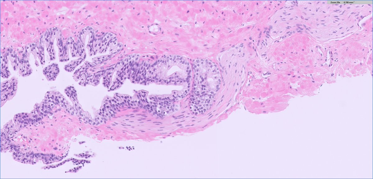 delicious #GUpath #beautyinb9 2-fer🔬in same case!

✔️mucinous metaplasia (pics 1/2)
✔️perineural indentation (pics 3/4)