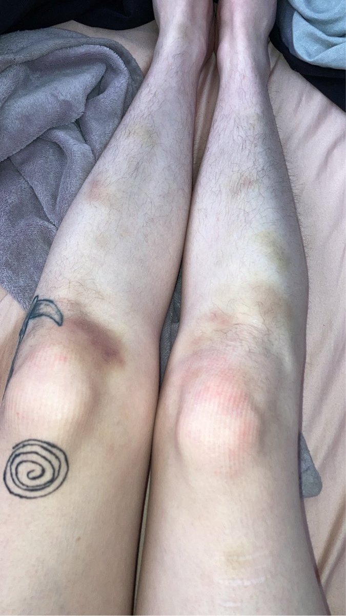 voidvermin's tweet photo. bruisecore 💜 https://t.co/ejpXTNMnTm