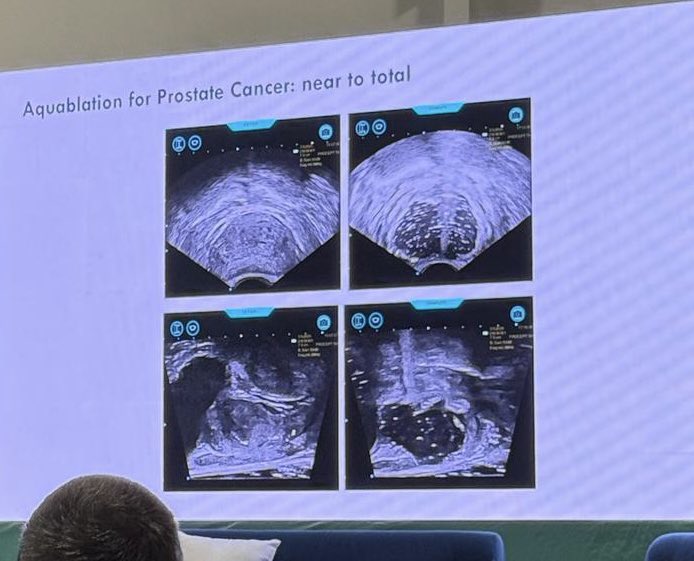 John Rewcastle, PhD (@rewcastle_john) on Twitter photo Inderbir Gill of <a href="/USCUrology/">USC Urology</a> presented the game changing design of WATER IV PCa at #AUA25: a randomized comparison of whole gland Aquablation and prostatectomy. The outcome could fundamentally change the management of #prostatecancer for many men Inderbir Gill of <a href="/USCUrology/">USC Urology</a> presented the game changing design of WATER IV PCa at #AUA25: a randomized comparison of whole gland Aquablation and prostatectomy. The outcome could fundamentally change the management of #prostatecancer for many men