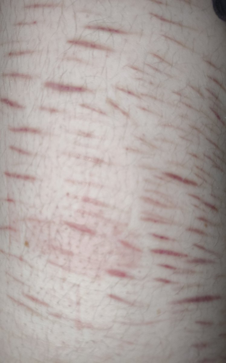 womanmakeme's tweet image. (all healed btw)
Pretty pathetic scar check, moved from cutting to binge eating from stress so I gained like 10 kg, thighs are fat as hell, my scars won't fade but they won't look good either, sigh somebody kill me deadass, and no I cba to shave my legs