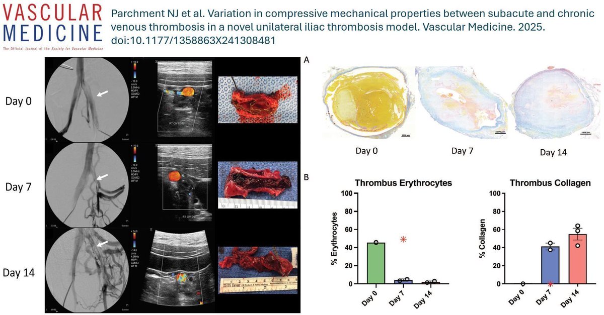 VascularMedicine (@vmj_svm) on Twitter photo From the Latest Issue: How do the mechanical properties of a venous thrombus change over time? Parchment, <a href="/AndreaObiMD/">Andrea Obi MD</a> and colleagues study these variations in a swine model.
buff.ly/3WwHemZ
#VTE #Thrombosis From the Latest Issue: How do the mechanical properties of a venous thrombus change over time? Parchment, <a href="/AndreaObiMD/">Andrea Obi MD</a> and colleagues study these variations in a swine model.
buff.ly/3WwHemZ
#VTE #Thrombosis