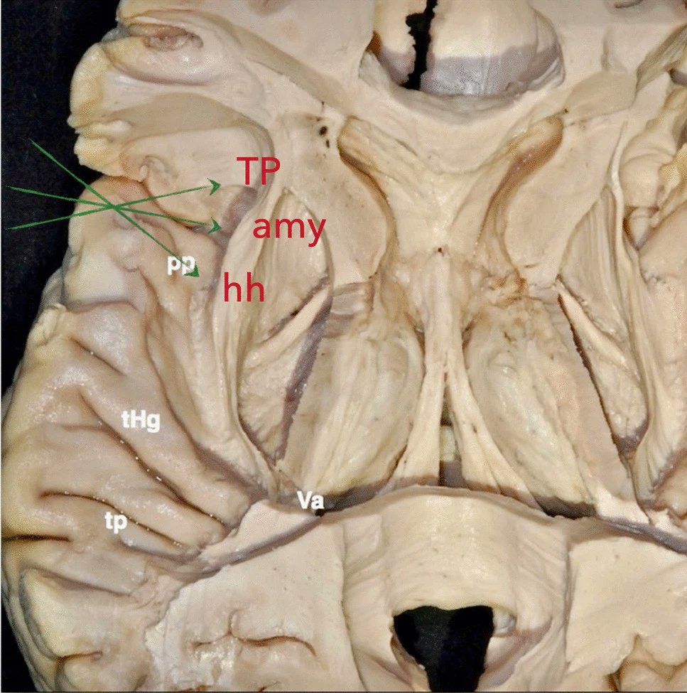 ActaNeuro's tweet photo. #OnlineFirst: Transplanum polare approach to the anterior mesiotemporal region
Check out the full article at: https://t.co/gpJv4BO1pL
#neurosurgery #mesiotemporal #planum #polare https://t.co/94rcaKdP3E