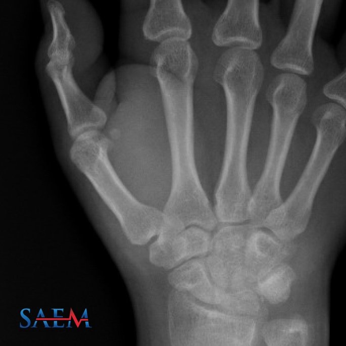 SAEM Clinical Images Series: Pain and Swelling in a Roofer's Right Hand

aliem.com/saem-clinical-…

<a href="/SAEMonline/">SAEM</a>