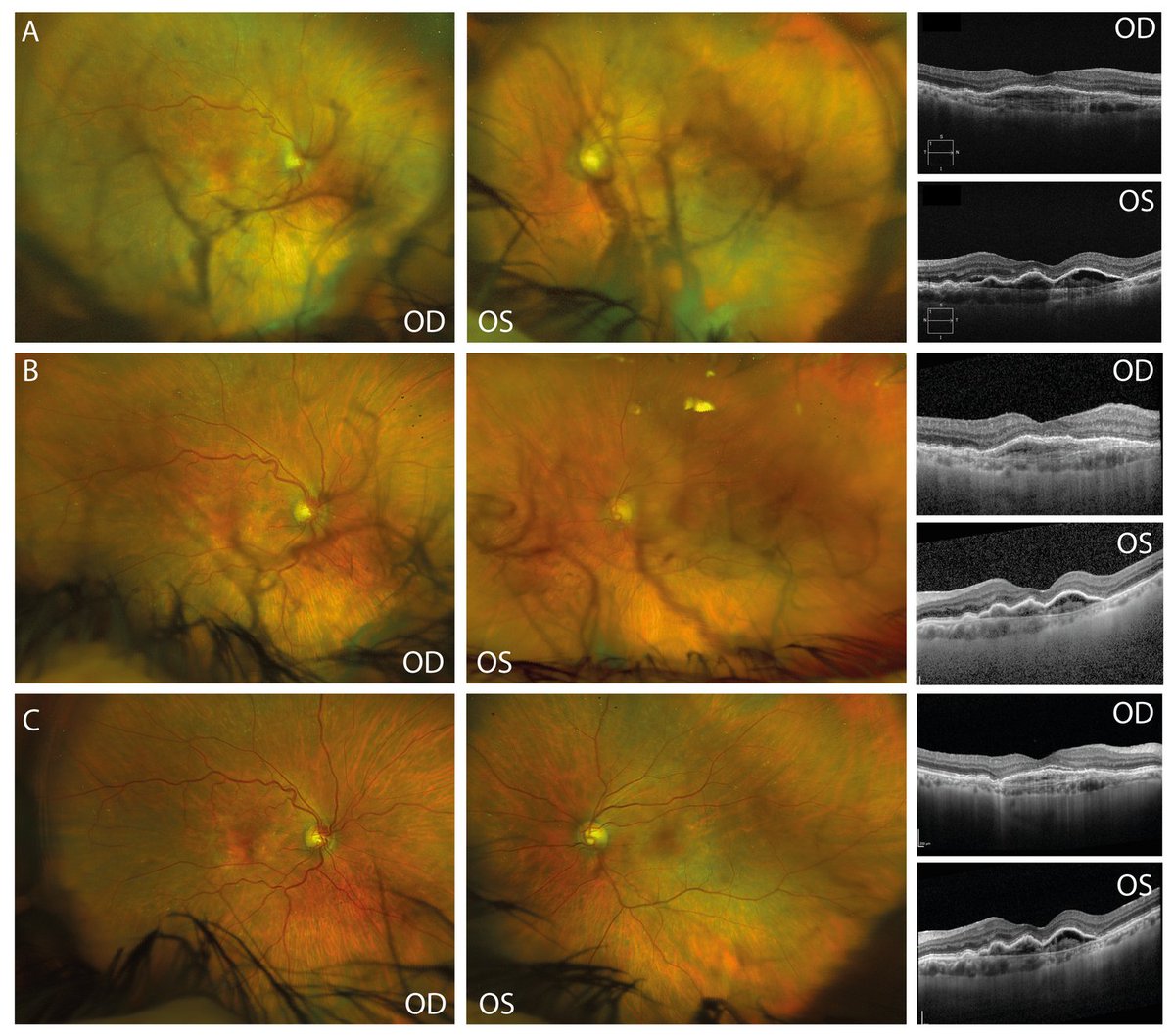 Graefes  rdcu.be/edSSX 
intraocular inflammation may occur after faricimab injections. Recovery may take weeks.
<a href="/ClinMedJournals/">Springer Medicine</a> <a href="/Ophthalmologen/">DOG-Augenheilkunde</a> <a href="/meyer_professor/">Carsten H. Meyer</a> <a href="/oliverzeitz/">Oliver Zeitz</a> <a href="/AndrzejGrzybow/">Andrzej Grzybowski</a> <a href="/EdmundTsuiMD/">Edmund Tsui, MD</a> @kopicAndrijana <a href="/JiaHorungMD/">Jia-Horung Hung</a> <a href="/KusuharaSentaro/">Sentaro Kusuhara</a> <a href="/SN_Ophthalmol/">Springer Nature Ophthalmology</a>