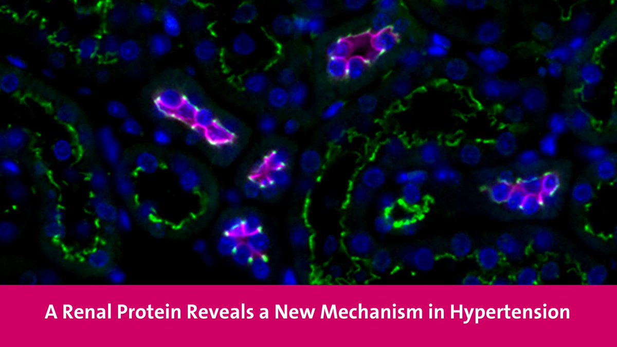 UNIGE_en (@unige_en) on Twitter photo High blood pressure is one of the main risk factors for cardiovascular diseases🫀. UNIGE scientists discovered a new mechanism involved in blood pressure regulation, opening the door to novel therapeutic approaches. <a href="/sciences_UNIGE/">Faculty of Science | UNIGE</a> <a href="/sandraciti/">Sandra Citi</a>
More info👉unige.ch/medias/en/2025… High blood pressure is one of the main risk factors for cardiovascular diseases🫀. UNIGE scientists discovered a new mechanism involved in blood pressure regulation, opening the door to novel therapeutic approaches. <a href="/sciences_UNIGE/">Faculty of Science | UNIGE</a> <a href="/sandraciti/">Sandra Citi</a>
More info👉unige.ch/medias/en/2025…