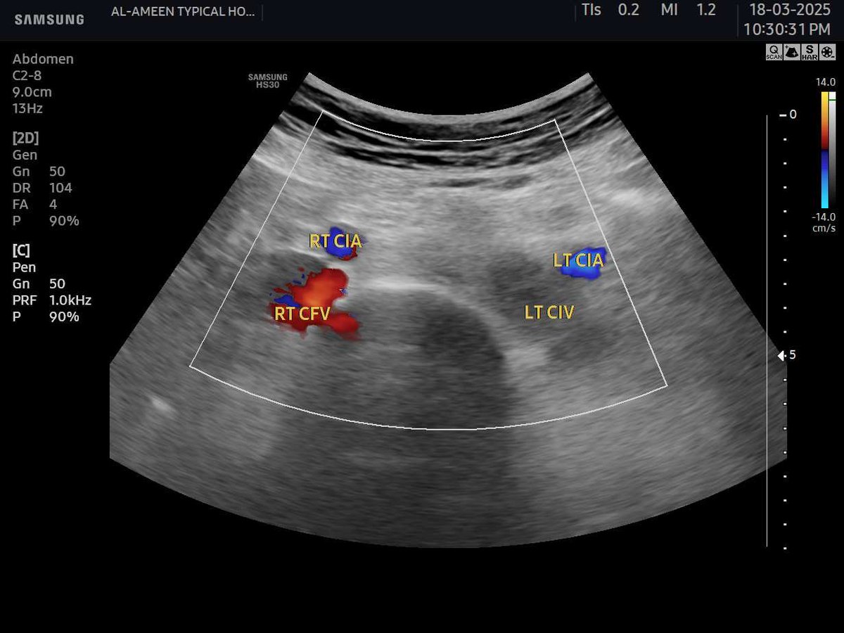 EchoTech_4's tweet photo. a case of May thurner syndrome.
Focus here —> when you see a complete occlusion to all lower limb “Deeb and superficial veins” try to Exclude a very dangerous complication as Phlegmasia cerulea dolens (PCD) ,assess the ARTERIAL System Carefully.
#Echo_Tech #doppler #POCUS https://t.co/bk0PskG2cf