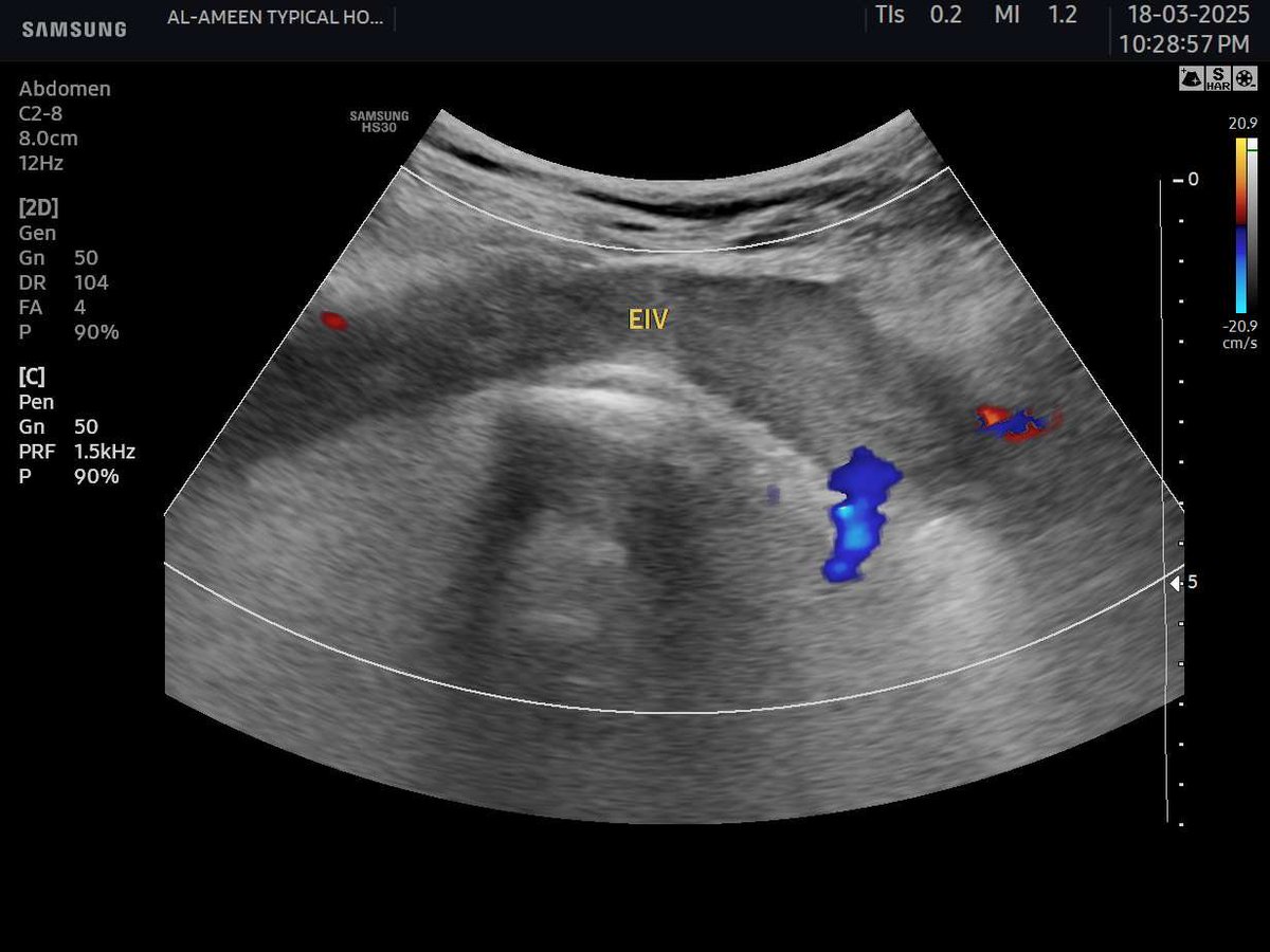 EchoTech_4's tweet photo. a case of May thurner syndrome.
Focus here —> when you see a complete occlusion to all lower limb “Deeb and superficial veins” try to Exclude a very dangerous complication as Phlegmasia cerulea dolens (PCD) ,assess the ARTERIAL System Carefully.
#Echo_Tech #doppler #POCUS https://t.co/bk0PskG2cf