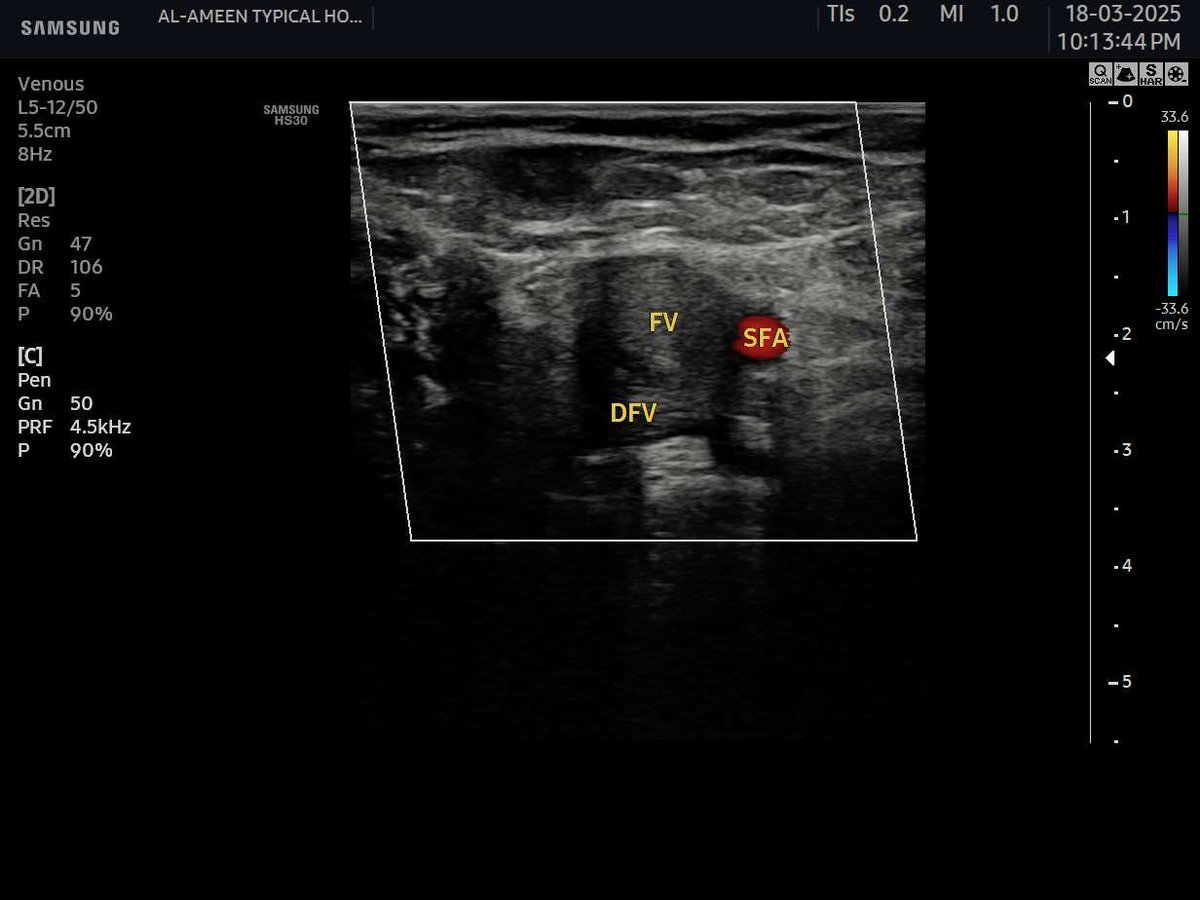 EchoTech_4's tweet photo. a case of May thurner syndrome.
Focus here —> when you see a complete occlusion to all lower limb “Deeb and superficial veins” try to Exclude a very dangerous complication as Phlegmasia cerulea dolens (PCD) ,assess the ARTERIAL System Carefully.
#Echo_Tech #doppler #POCUS https://t.co/bk0PskG2cf