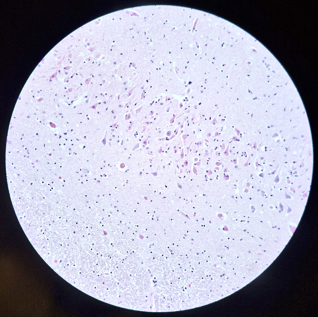 zivaledinek's tweet photo. Here is a striking example of 🔴 red neurons (eosinophilic cytoplasm, dark and shrunken aka pyknotic nuclei) — a classic histopathologic sign of diffuse hypoxic-ischemic brain injury 🧠 #NeuroPath #MedEd #TeachingTuesday #PathTrainee
#AutopsyPath https://t.co/KtIbLs7lrF