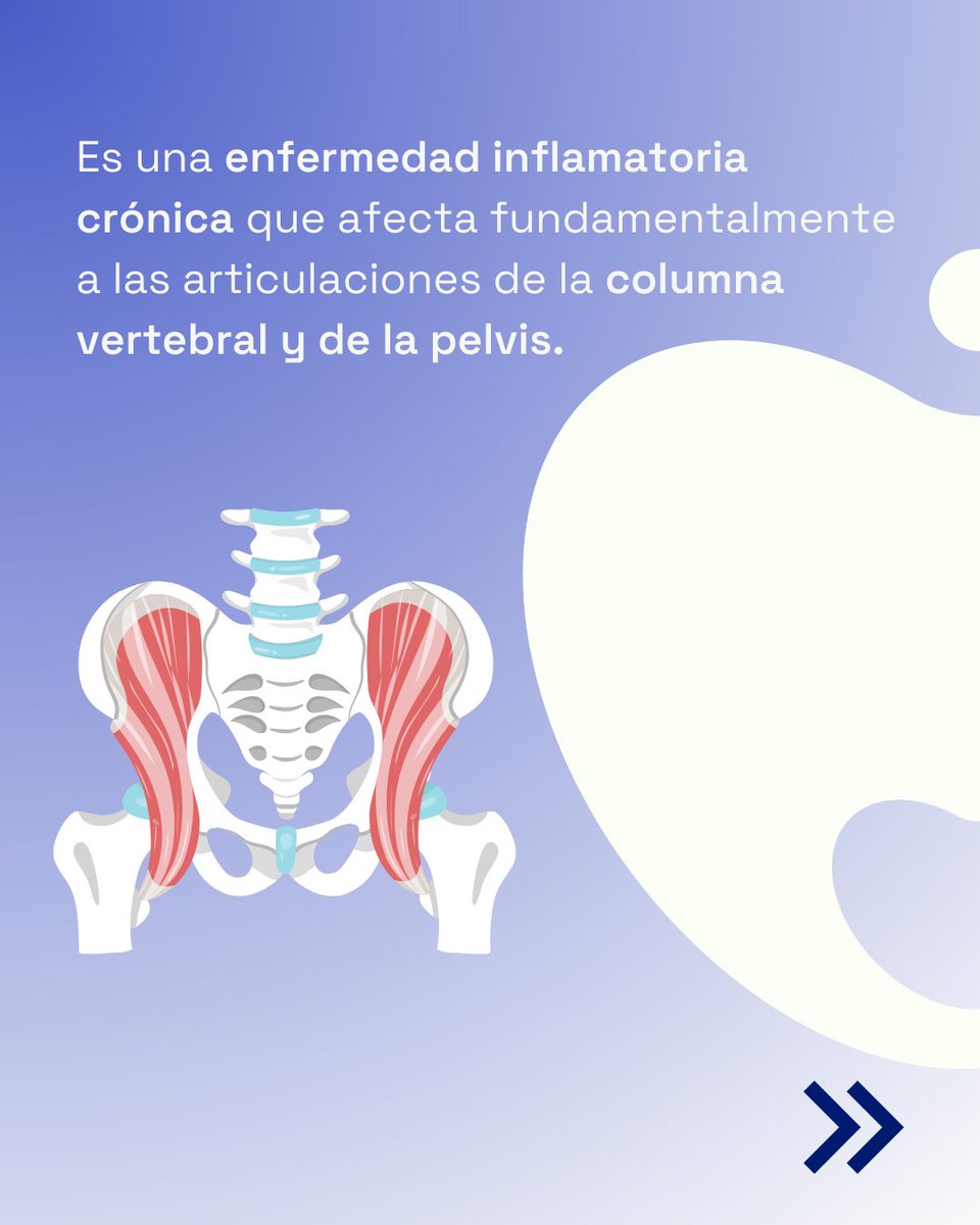 SEReumatologia's tweet image. 💡 ¿Sabías que la #espondiloartritisaxial afecta a aproximadamente 96.000 personas en #España? 

🗓️ En el #DíaMundialdelaEspondiloartritisAxial, recordamos la importancia de conocer los síntomas para acudir al especialista y lograr un diagnóstico precoz.

@CEADE_  #WorldASDay