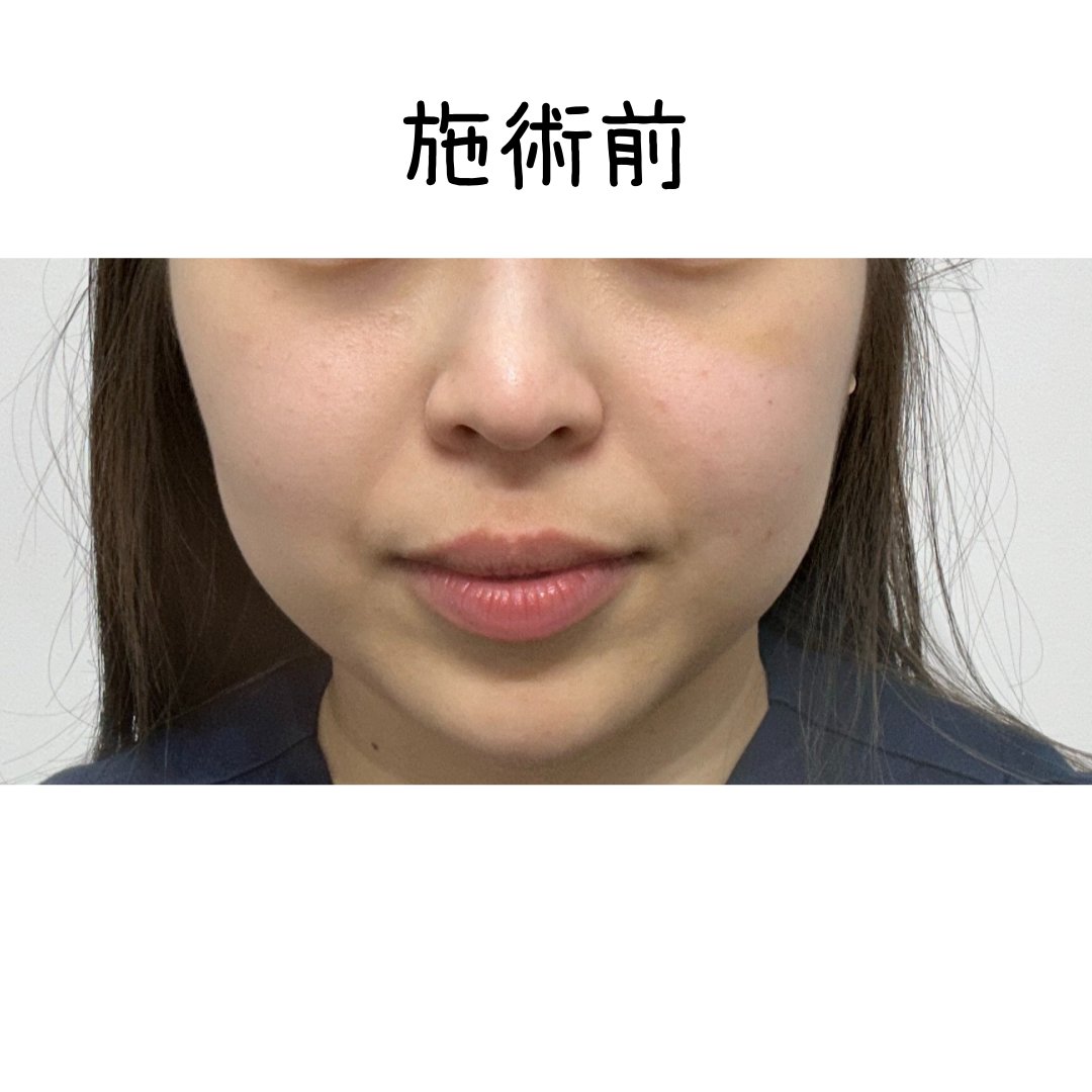 megurimegugu's tweet photo. 今日リザーブ美容外科で ミント糸でリフトしました！
 フェイスラインがスッキリして 
大満足しています！！  
@reserveps_jp

#糸リフト #釜山 #釜山整形外科 #ミント糸 https://t.co/gefmFJzJFp