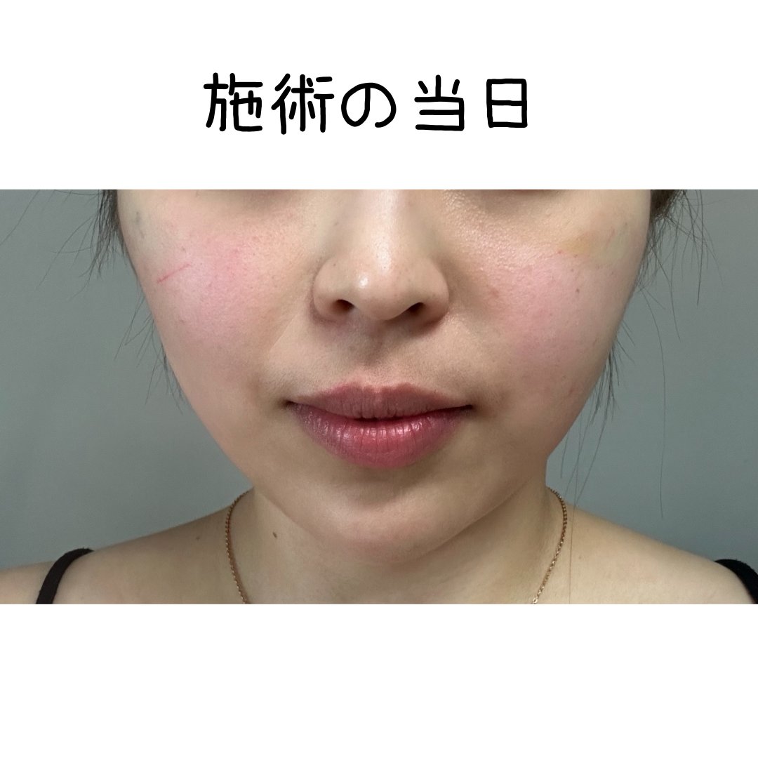 megurimegugu's tweet photo. 今日リザーブ美容外科で ミント糸でリフトしました！
 フェイスラインがスッキリして 
大満足しています！！  
@reserveps_jp

#糸リフト #釜山 #釜山整形外科 #ミント糸 https://t.co/gefmFJzJFp