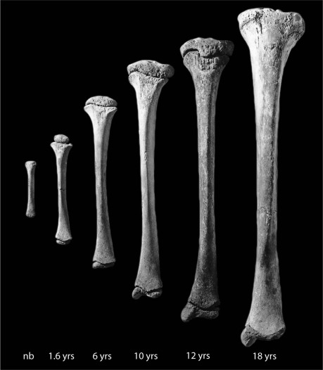 aestheticprimal's tweet photo. Your bones will grow at a rapid rate once you understand the importance of mineral balance.

Your bones are like a mineral reserve for the body, everytime your body is running low on magnesium, calcium, zinc or another trace mineral, the body will start breaking down it's own bone to free up the minerals stored in it.

And the opposite is also true, when your body has a surplus of minerals, it will actually create more bone to store these minerals in.

It is all mediated by the PTH:Calcitonin ratio, the lower, the better.

You keep the PTH:Calcitonin ratio low by:
- getting all minerals in (including rare trace minerals)
- vitamin D
- Tamarind (detox Fluoride)
- watch your calcium:phosphate ratio