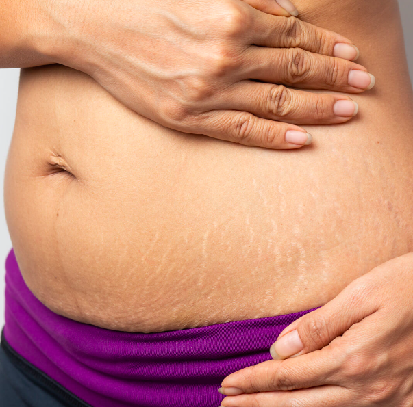 Say Goodbye To Stretch Mark - mailchi.mp/f2cc726b733e/s…