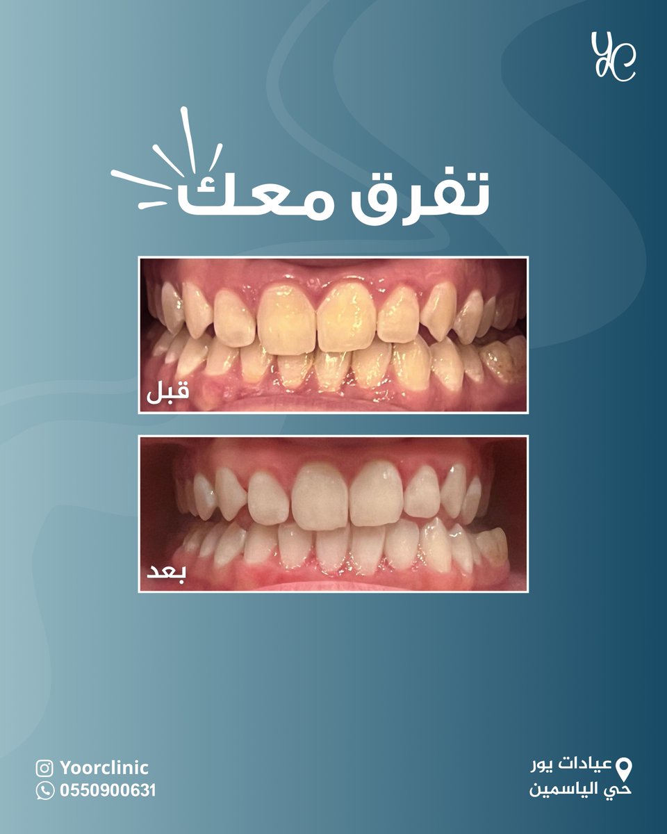 لمسات بسيطة تفرق معك 🪄 

حالة تنظيف وتلميع الأسنان✨
من عيادة د. أثير الفارس 

للحجز والاستفسار 
0550900631
#يور_كلينك #اسنان #الرياض