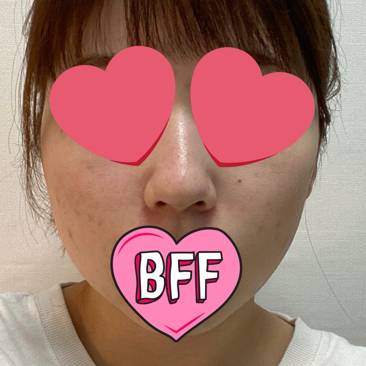 wonwoo61's tweet photo. ビギンさんで鼻フルしてDT7日目です！
綺麗すぎるし、見せた写真通りすぎてびっくりした🥹
骨切り幅寄せしてるから鼻根だけまだちょっと痛いけど、7日目でこれは予後が期待すぎる😭
(4枚目before)
#ビギン美容外科 #イジュチョル院長
#鼻整形 #韓国整形 #団子鼻 https://t.co/WqPce4Zrce