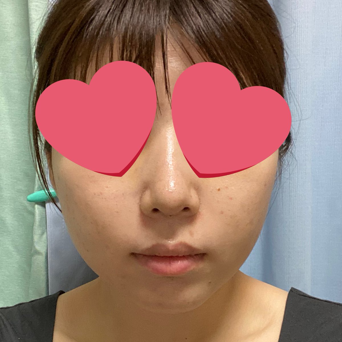 wonwoo61's tweet photo. ビギンさんで鼻フルしてDT7日目です！
綺麗すぎるし、見せた写真通りすぎてびっくりした🥹
骨切り幅寄せしてるから鼻根だけまだちょっと痛いけど、7日目でこれは予後が期待すぎる😭
(4枚目before)
#ビギン美容外科 #イジュチョル院長
#鼻整形 #韓国整形 #団子鼻 https://t.co/WqPce4Zrce