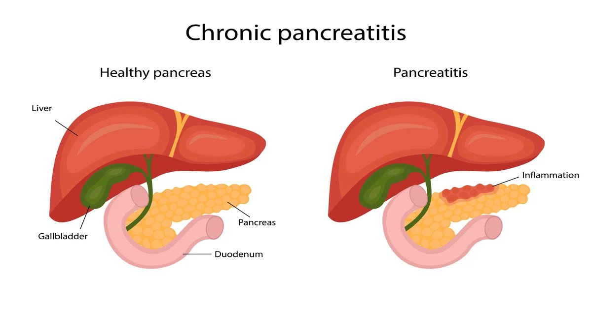 Gabepluguez's tweet photo. Your pancreas quietly keeps you alive every day:

• Digestion
• Energy production
• Blood sugar control

But no one knows how to protect it…

Until it’s too late.

Here's why it’s critical, symptoms of poor pancreas health, &amp; how to fix yours: https://t.co/LR5jtVlaSp
