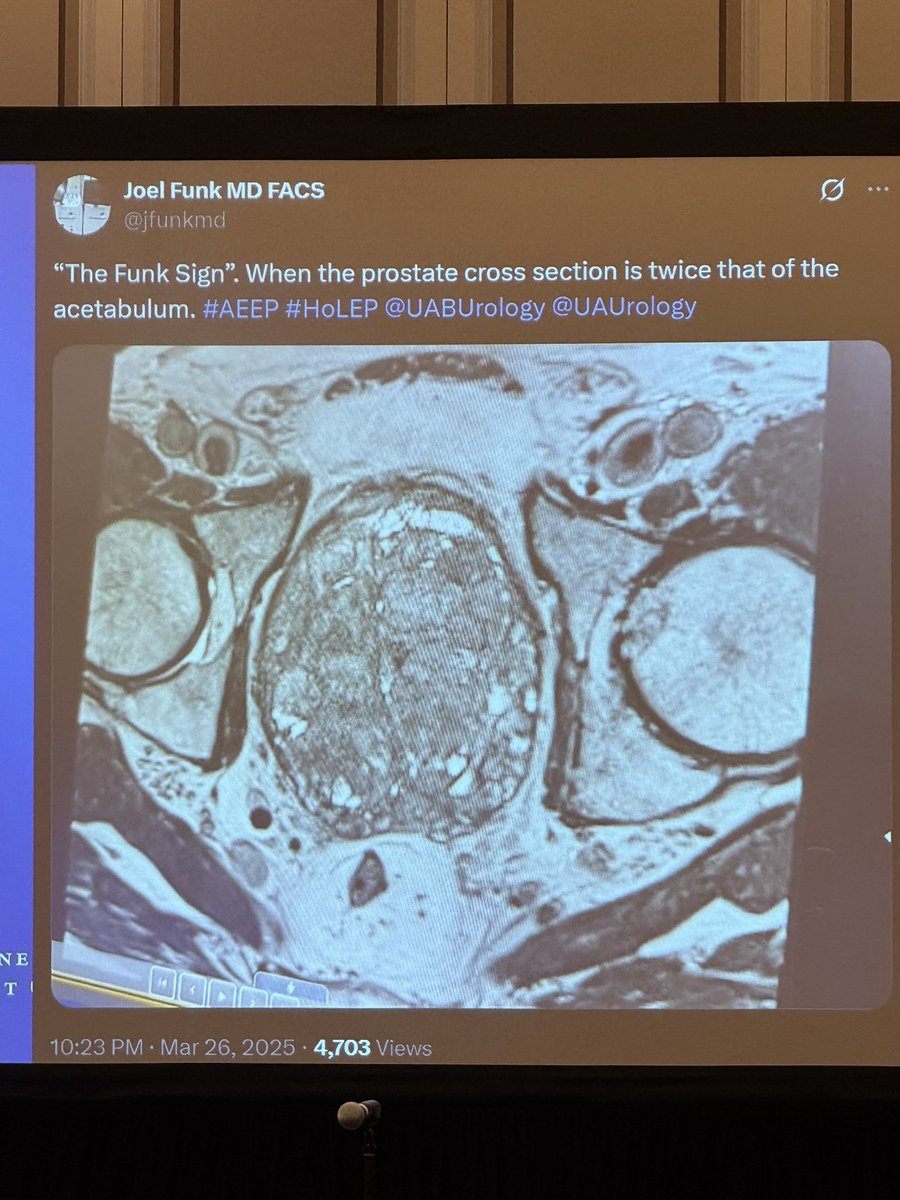 URMC Department of Urology (@urmcurology) on Twitter photo A true #masterclass in #HoLEP tackling “mega glands” by our guru <a href="/squarrier/">Scott Quarrier MD MPH</a> to close out #AUA25 with a bang!
Key #takeaway - mega glands are doable and these pts do very well!
<a href="/AmerUrological/">Amer. Urol. Assn.</a> <a href="/Endo_Society/">Endourological Society</a> <a href="/jfunkmd/">Joel Funk MD FACS</a> <a href="/amy_krambeck/">Amy Krambeck</a> A true #masterclass in #HoLEP tackling “mega glands” by our guru <a href="/squarrier/">Scott Quarrier MD MPH</a> to close out #AUA25 with a bang!
Key #takeaway - mega glands are doable and these pts do very well!
<a href="/AmerUrological/">Amer. Urol. Assn.</a> <a href="/Endo_Society/">Endourological Society</a> <a href="/jfunkmd/">Joel Funk MD FACS</a> <a href="/amy_krambeck/">Amy Krambeck</a>