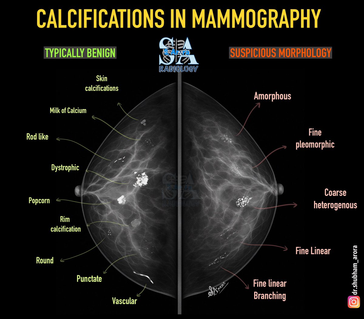 Dr_S_Arora's tweet image. Slide on breast mammography calcification
#radiology #MedX