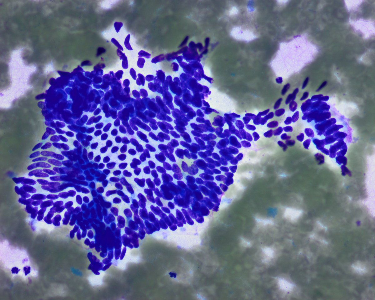 Pepe Jiménez Heffernan (@pepeheffernan) on Twitter photo CC361. FNA of a nodule in the cheek in a woman with previous history of oropharyngeal squamous cell carcinoma. More images below. I will give you a hint: not its typical location <a href="/kriyer68/">Kalyani Bambal</a> <a href="/DrBMcGinn/">Barry McGinn</a> <a href="/goziemnweke/">idlewild</a> CC361. FNA of a nodule in the cheek in a woman with previous history of oropharyngeal squamous cell carcinoma. More images below. I will give you a hint: not its typical location <a href="/kriyer68/">Kalyani Bambal</a> <a href="/DrBMcGinn/">Barry McGinn</a> <a href="/goziemnweke/">idlewild</a>