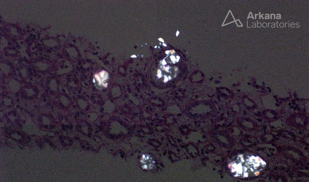 Polarizable calcium oxalate microcrystals in a 16-year-old who ingested a small volume (&lt;10 mL) of oxalic acid solution + grain alcohol (90% ethanol). The patient presented with a diffuse morbilliform rash, intermittent fevers, oral lesions and alterations in taste, and a 10-day